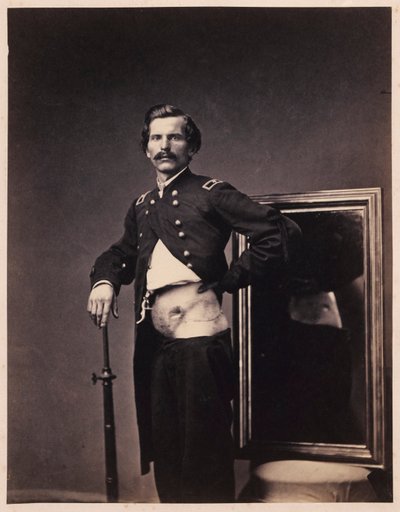 Major H. A. Barnum, Recovery after a Penetrating Gunshot Wound of the Abdomen with Perforation of the Left Ilium, from the Photographic Catalogue of the Surgical Section by William Bell