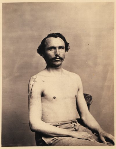 Private Adolph Zirsse, Successful Intermediate Excision of the Head and two and a half inches of the Shaft of the Right Humerus, from the Photographic Catalogue of the Surgical Section by William Bell