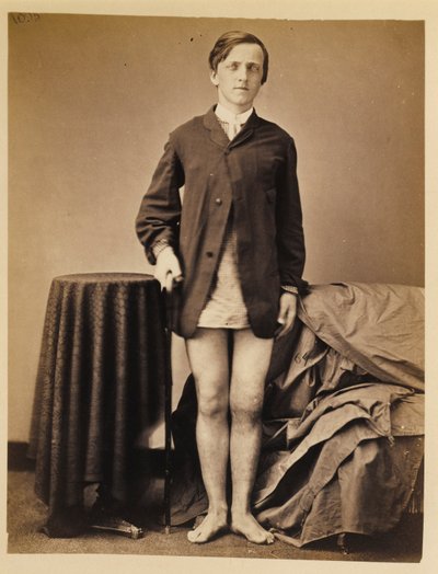 Private G. W. Warrington, Recovery, without Amputation, after Gunshot Fracture of the Right Patella, from the Photographic Catalogue of the Surgical Section by William Bell
