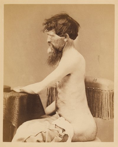 Private John Bar, Recovery after a Penetrating Wound of the Abdomen with Fracture of the Left Os Innominatum, from the Photographic Catalogue of the Surgical Section by William Bell