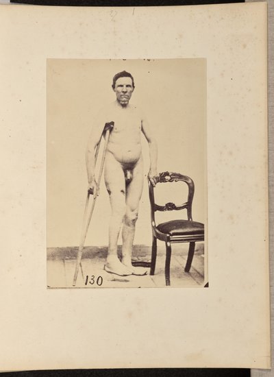 Consolidated Gunshot Fracture of the Middle Third of the Right Femur by William H. Bell