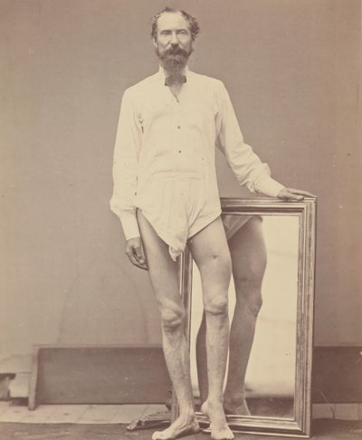 Gunshot Wound of Middle Third of Left Femur by William H. Bell