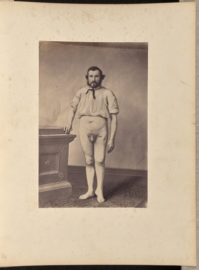 Successful Excision of the Head of the Left Femur for Gunshot Fracture by William H. Bell