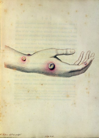 Cowpox pustule on the arm of Sarah Nelmes, from 
