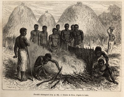 Surgical method used to heal fractures, the wounded is seated in a hole, the leg is banished by a leaf, then the pit is filled with mud and covered with buds that are inflamed and heat the fracture, the patient is protected by a mat that serves as a screen by Edouard Riou