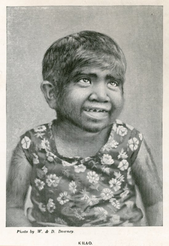 Krao, The Missing Link, Exhibited at the Aquarium, Westminster, London, in 1887 by English Photographer