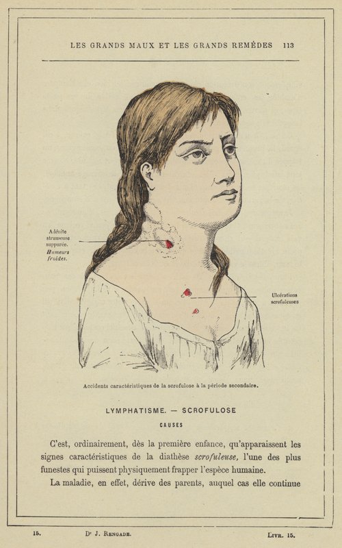 Characteristic accidents of scrofula in the secondary period by French School