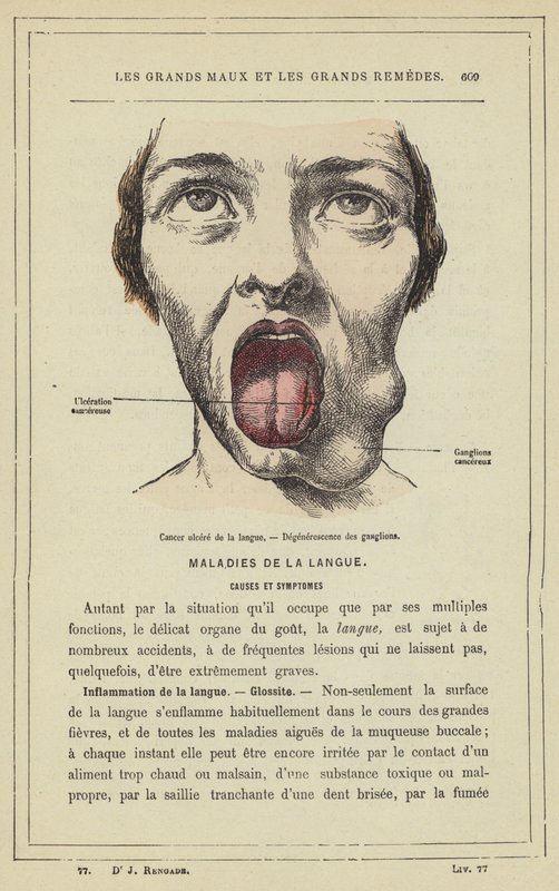 Ulcerated Cancer of the Tongue, Degeneration of the Glands by French School