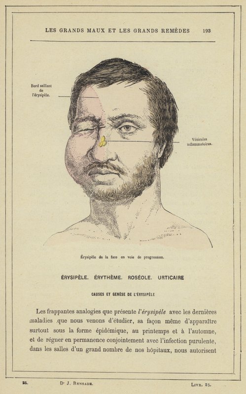 Progressing Facial Erysipelas by French School