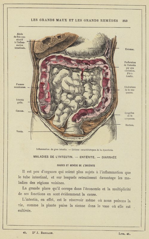 Inflammation of the Large Intestine, Characteristic Lesions of Dysentery by French School