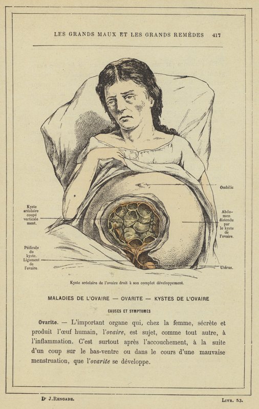 Areolar cyst of the right ovary at its complete development by French School