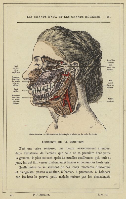 Dental Nerves, Mechanism of Toothache Caused by Tooth Decay by French School