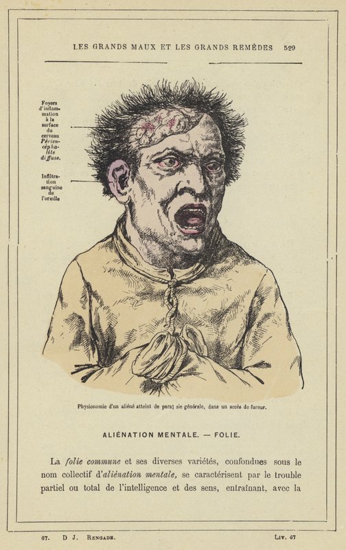 Physiognomy of an Insane Person with General Paralysis, in a Fit of Fury by French School