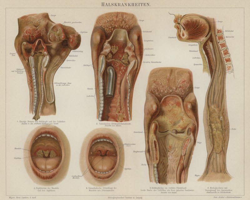 Diseases of the throat by German School
