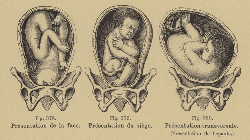 Malpresentation of Babies in the Womb Before Birth by German School