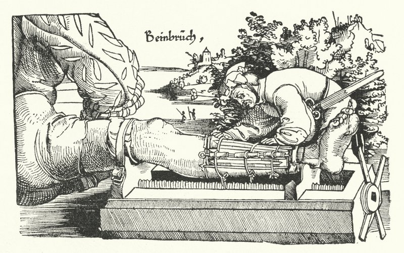 Treating a Fractured Leg by German School