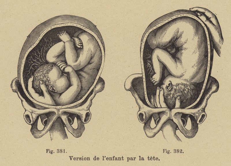 Turning a Baby in Its Mother
