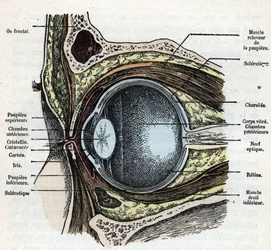 Vertical cut of an eyeball with cataract Engraving from 