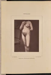Generalized Vesicular Syphilis