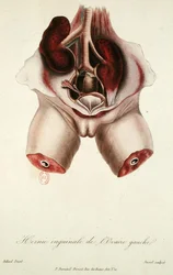 Inguinal hernia of the left ovary, from 