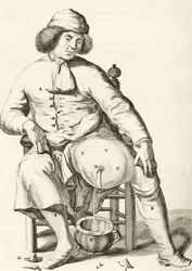 Draining fluid from an abscess, from Exercitationes Practicae circa Medendi Methodum by Frederik Dekkers, 1694