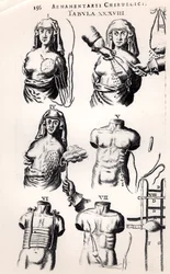 Operating on breast cancer, from Armamentarii Chirurgici by Johannes Schultes (1595-1645), published in Amsterdam, 1672