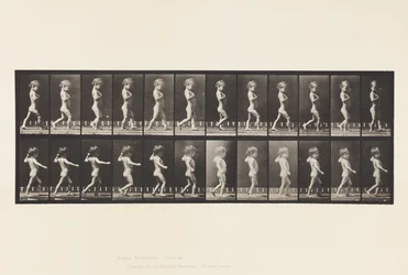 Bow Legs; Boy; Spinal Caries; Girl Walking