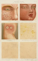 Eruptive Fevers