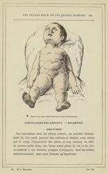 Attitude of a Young Child Suffering from Eclamptic Convulsions