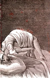 Hysteria, Mental and Nervous Disorder, Arising from Intense Anxiety. 1887