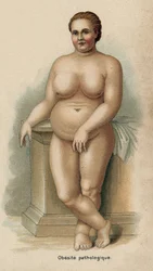 Portrait of a Woman with Pathological Obesity