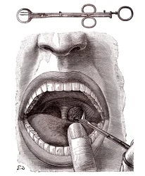 Tonsillectomy