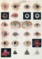 Description of congenital eye anomalies, from Klinische Darstellungen der Krankheiten und Blidungsfehler des Menschlichen Auges, by Friedrich August von Ammon, 1838