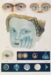 Description of congenital eye anomalies, from Klinische Darstellungen der Krankheiten und Blidungsfehler des Menschlichen Auges, by Friedrich August von Ammon, 1838