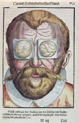 Treating an Eye Condition, from Ophthalmodouleia by Georg Bartisch, published in Dresden in 1583
