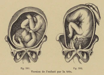 Turning a Baby in Its Mother