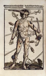 The Wound Man, from the 