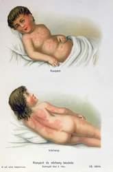 Measles and scarlet fever, from a family medical book, c.1900