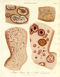 Pathological Skin Conditions: Schurigie, Leprous Skin, Pallada and Impetigo