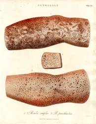 Skin Eruptions - Roseola simplex and Roseola paristhmitica
