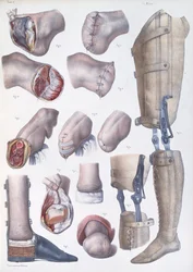Amputations and Prosthetics, plate from 