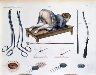 An operation on a vesicovaginal fistula, plate from 
