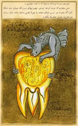 Anatomical View of a Tooth, the Source of Toothache is Shown as a Demon of Hell