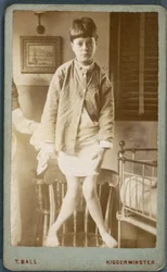 Diseases, Rickets Child with rickets
