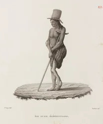 Diseases, Tropical Diseases Man with elephantiasis, Guam