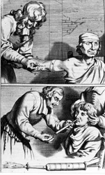 Bleeding and nasal shower by Johannes Sculpteti "Armamentarium Surgery" Amsterdam 1672